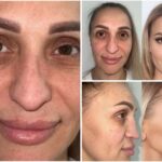 Woman Travels to Turkey for Transformation Surgery & She Looks Totally Unrecognisable After