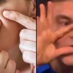People Who Pop Their Pimples are Warned About Squeezing Them Around the 'Triangle of Death'