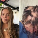 Young Woman Claims Catching Covid Eight Times Led to Hair Loss
