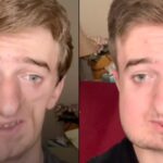 Man with Rare Condition Causing Half of Face to Shrink Shares 'Hardest Part' of Coping